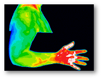 Diabetes Red Glove